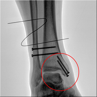 【醫(yī)療科普】之內(nèi)踝骨折 【醫(yī)療科普】之內(nèi)踝骨折