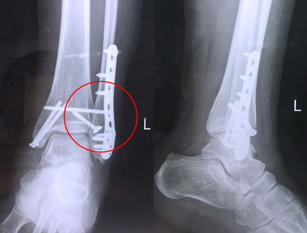 【醫(yī)療科普】之外踝骨折 【醫(yī)療科普】之外踝骨折