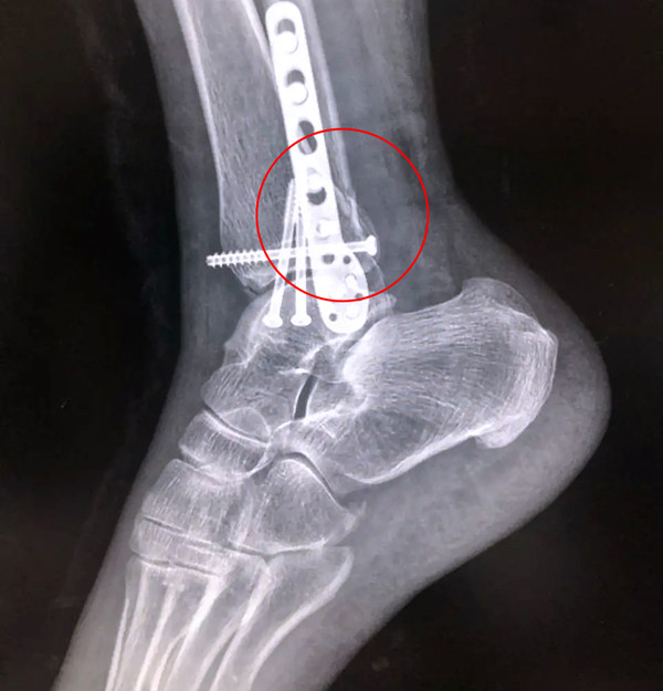 【醫(yī)療科普】之后踝骨折 【醫(yī)療科普】之后踝骨折