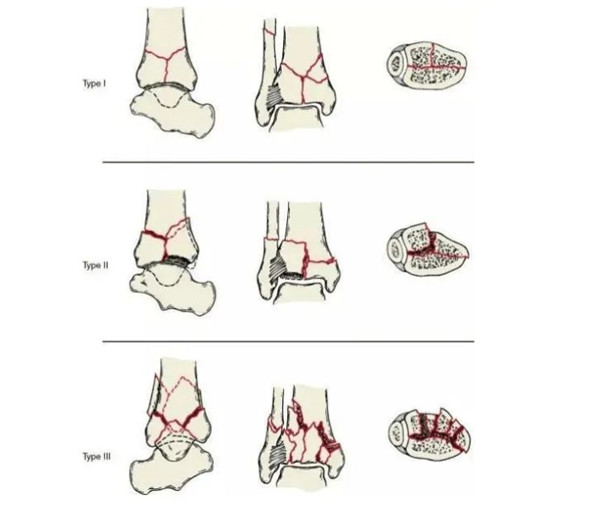 【醫(yī)療科普】Pilon骨折 【醫(yī)療科普】Pilon骨折