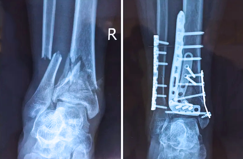 【醫(yī)療科普】:關(guān)節(jié)內(nèi)的骨折 【醫(yī)療科普】:關(guān)節(jié)內(nèi)的骨折