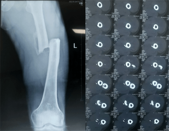 大平板一體式C形臂術(shù)前檢查 大平板一體式C形臂術(shù)前檢查