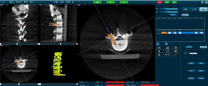 脊柱微創(chuàng)手術(shù)機器人-定位準確 脊柱微創(chuàng)手術(shù)機器人-定位準確