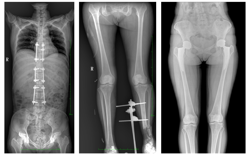 大視野平板動(dòng)態(tài)DR臨床影像 大視野平板動(dòng)態(tài)DR臨床影像