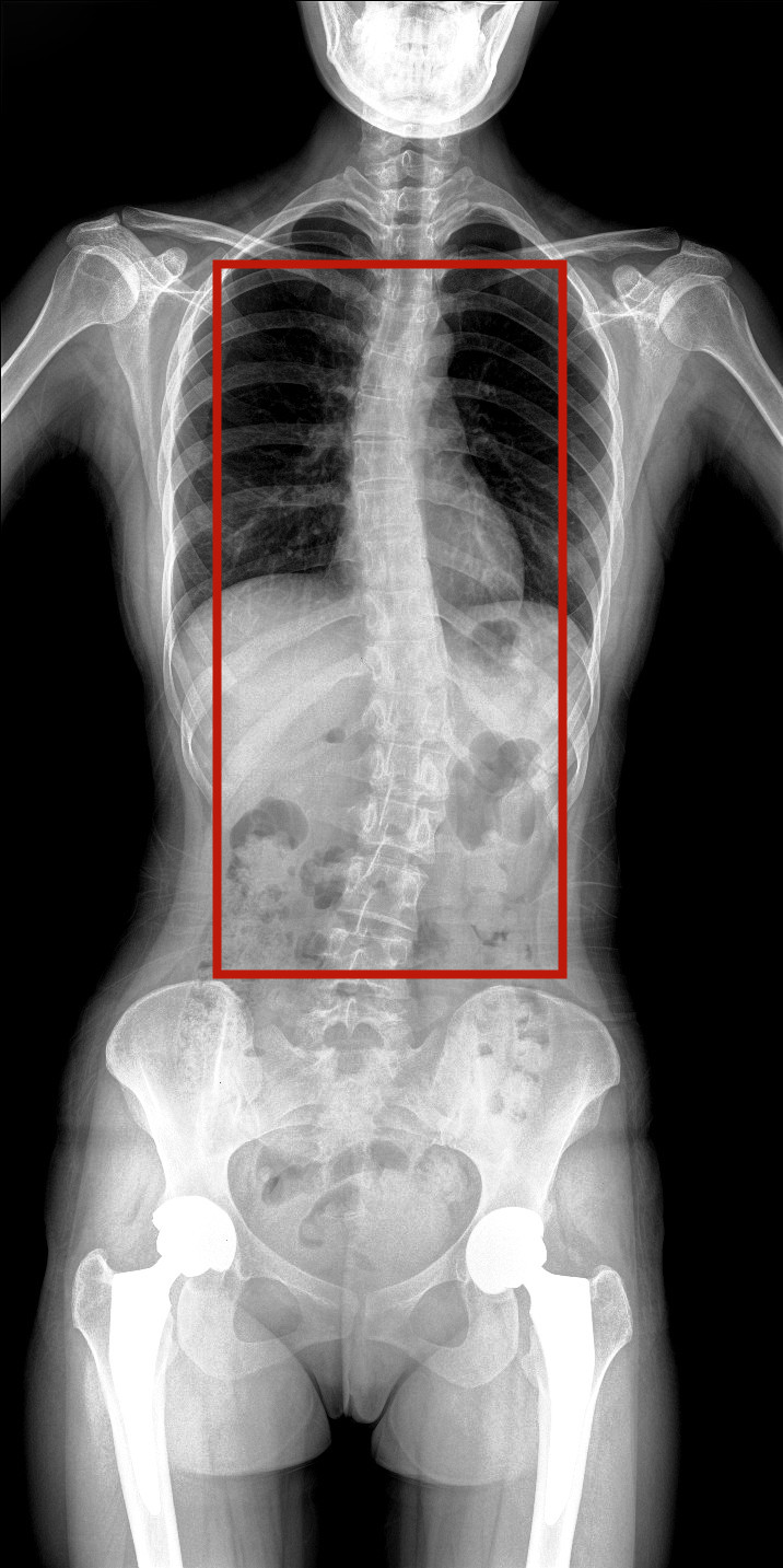全脊柱動態(tài)DR圖像 全脊柱動態(tài)DR圖像