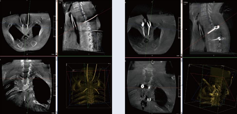 術(shù)中三維C形臂影像在脊柱導(dǎo)航機器人系統(tǒng)中的應(yīng)用 術(shù)中三維C形臂影像在脊柱導(dǎo)航機器人系統(tǒng)中的應(yīng)用