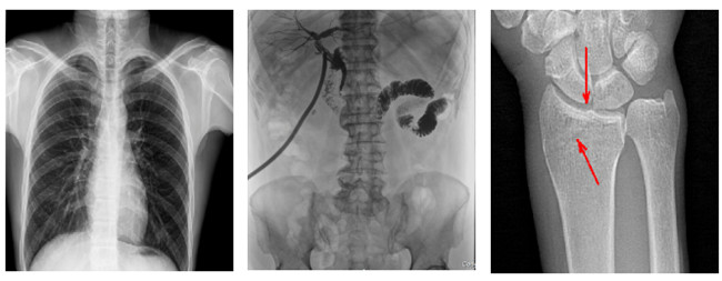 懸吊動態(tài)DR臨床圖像 懸吊動態(tài)DR臨床圖像